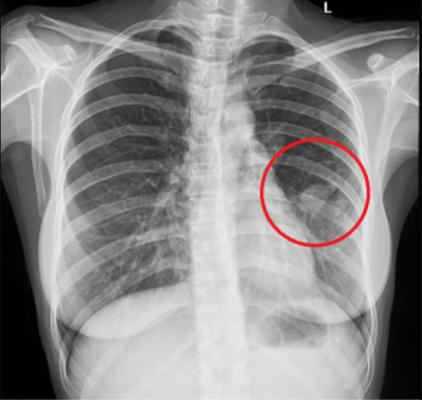 Chụp X Quang phổi - Chụp X quang có phát hiện ung thư không?