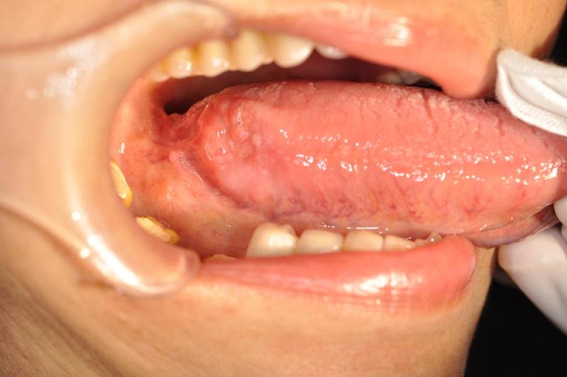 Nổi hạch dưới lưỡi có phải là dấu hiệu cảnh báo bệnh ung thư lưỡi không? 1