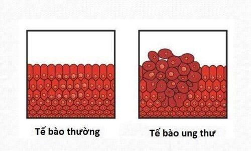 Tế bào ung thư tăng sinh vô tổ chức rất khác với tế bào thường