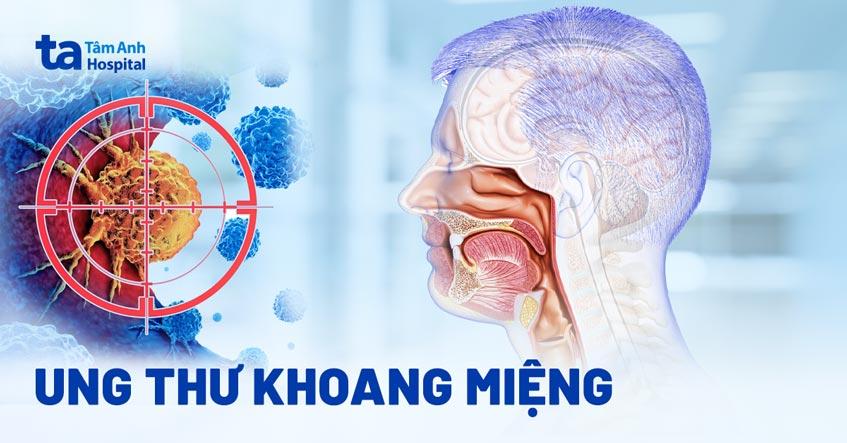 ung thư khoang miệng