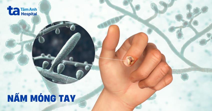 Nấm móng tay: Hình ảnh, dấu hiệu, nguyên nhân và phòng ngừa