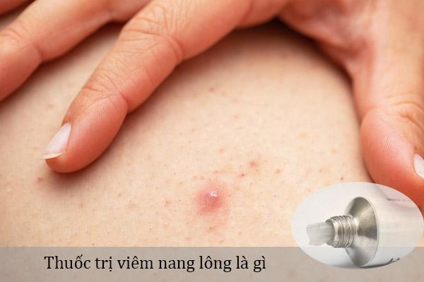 Thuốc trị viêm nang lông dùng để diệt virus, vi khuẩn gây nên bệnh