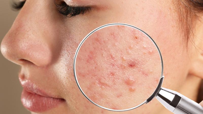 Thâm mụn do đâu mà ra? Cách trị thâm mụn hiệu quả