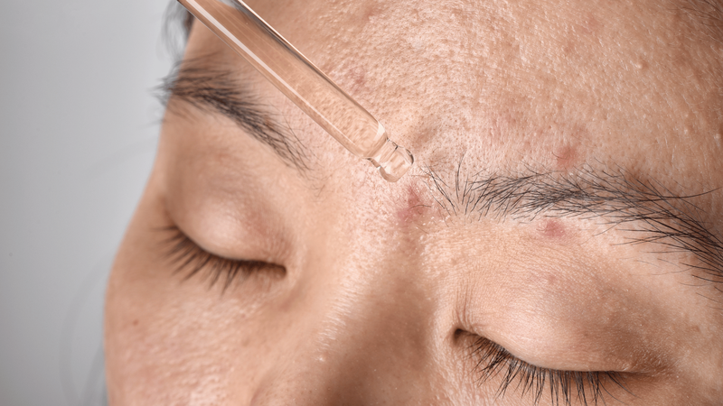 Top 5 serum trị mụn hiệu quả được nhiều người tin dùng